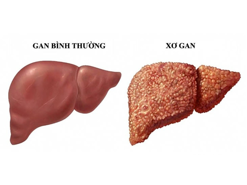 co-4-trieu-chung-khi-uong-ruou-ban-can-di-kham-xo-gan-ngay-lap-tuc