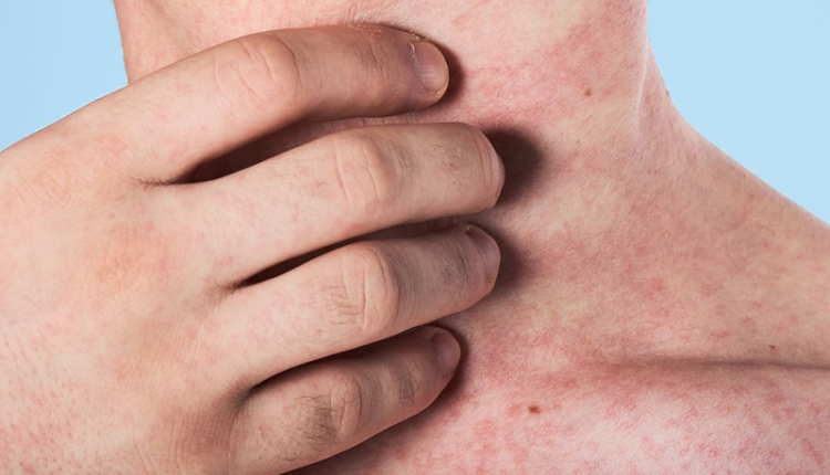 ban-soi-co-ngua-khong-nhung-dieu-ban-can-hieu-ro